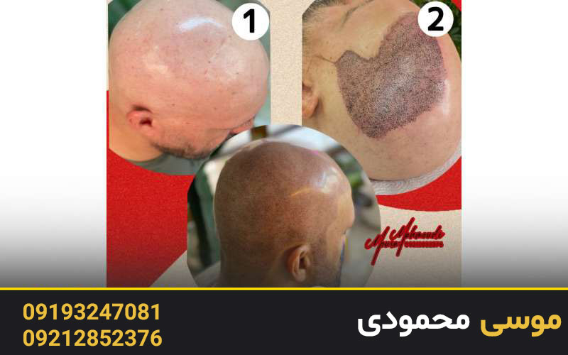 مزایای اسکالپ سه بعدی نسبت به کاشت مو