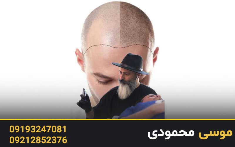 مراقبت‌های بعد از اسکالپ سه بعدی