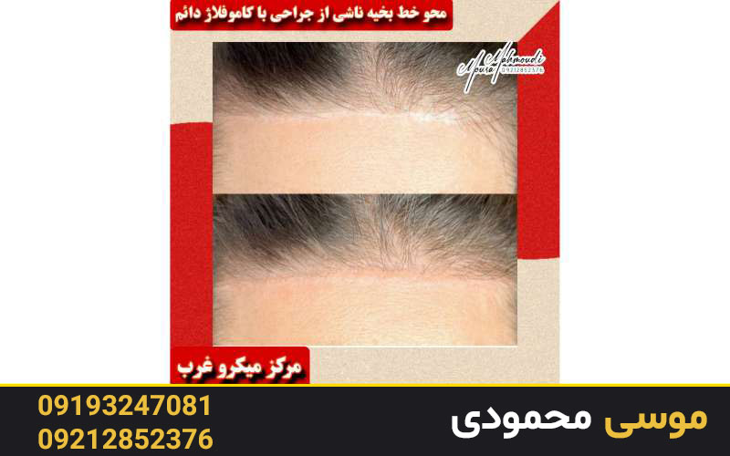 مراقبت‌های بعد از روش کاموفلاژ دائم چیست؟