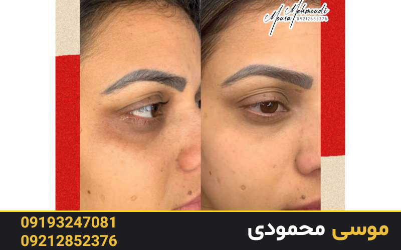 عوارض کاموفلاژ دائم