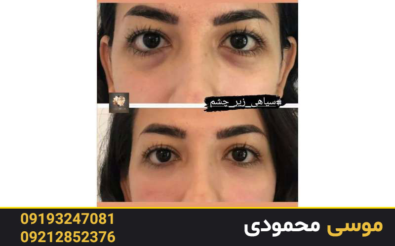 کاموفلاژ دائمی برای رفع تیرگی دور چشم