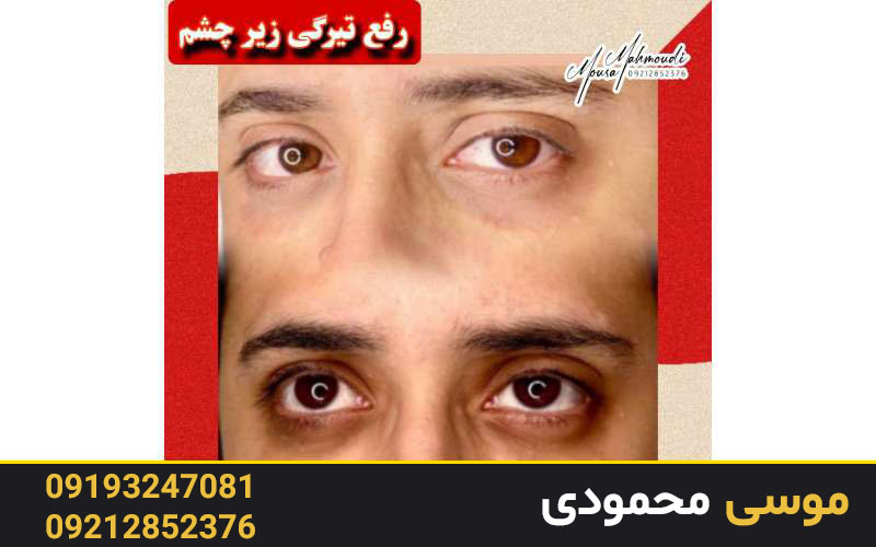 کاموفلاژ دائمی و بهترین دستگاه کاموفلاژ