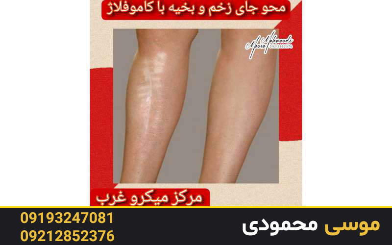  درمان بیماری پوستی پلاسما با کاموفلاژ دائم