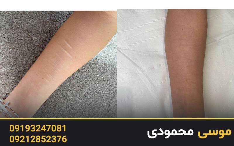 روش‌های مختلف کاور سوختگی و بریدگی