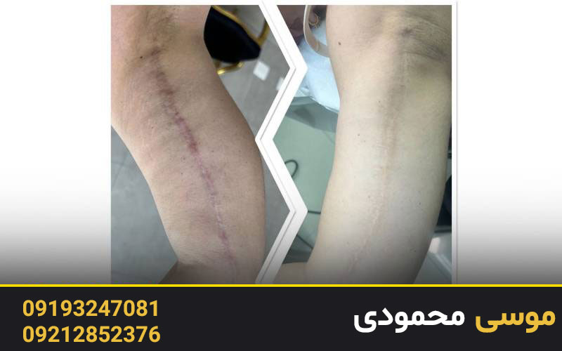 زمان مناسب تاتو برای کاور سوختگی و بریدگی