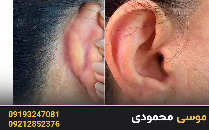 کاور سوختگی و بریدگی در کلینیک میکرو غرب