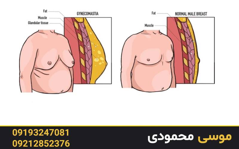 رفع اسکار ژنیکوماستی با تاتو پزشکی در میکرو غرب