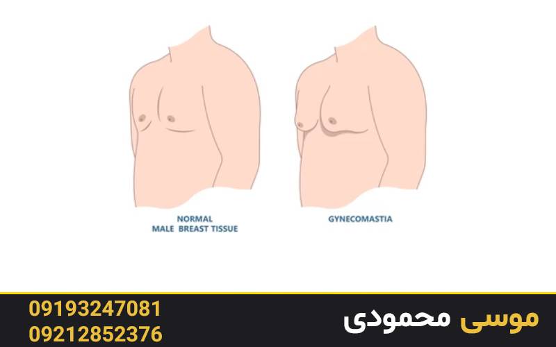 مراحل رفع اسکار ژنیکوماستی با تاتو پزشکی