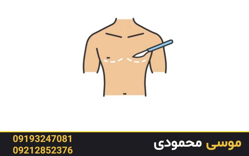نتیجه رفع اسکار ژنیکوماستی در میکرو غرب