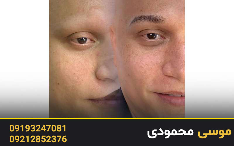 انجام فیبروز ابرو آقایان در کلینیک میکرو غرب