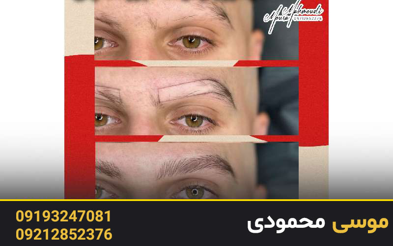 هزینه فیبروز ابرو آقایان