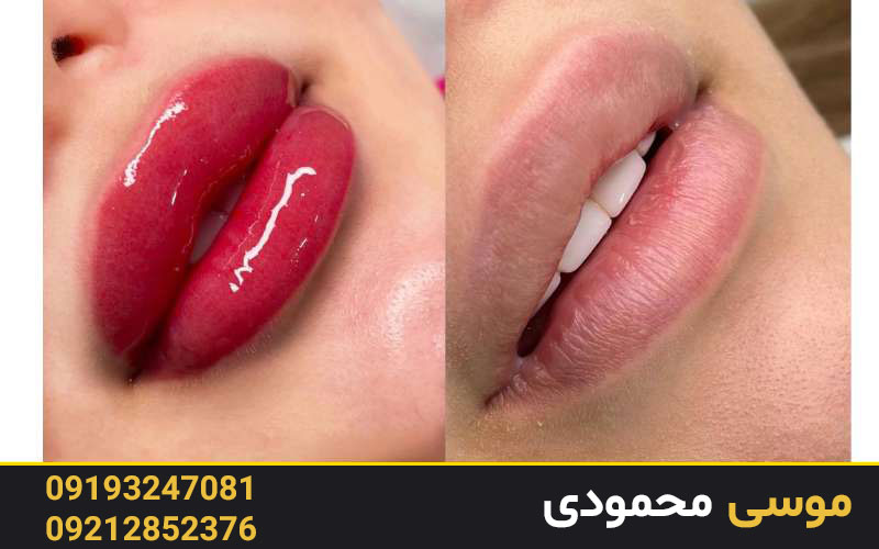 روند انجام رژ لب دائم آقایان و خانم ها در آکادمی میکرو غرب