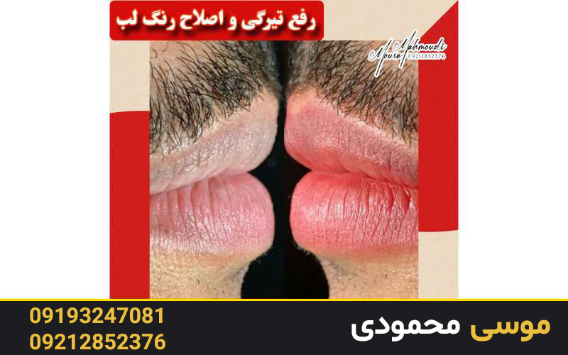 نکاتی در باب مراقبت‌های بعد از رژ لب دائم