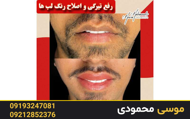 انواع روش‌های رژ لب دائم آقایان و خانم ها