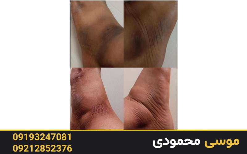 رفع تیرگی و سیاهی زانو و قوزک پا در کلینیک میکرو غرب