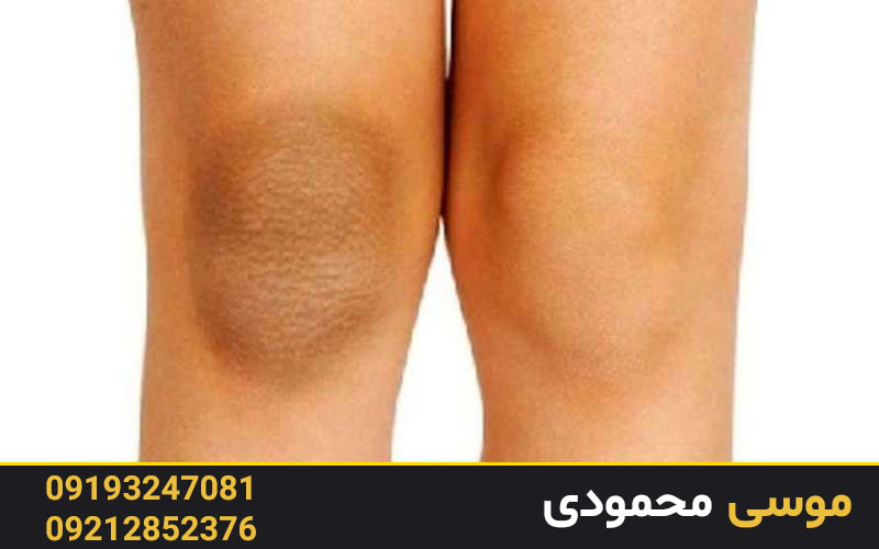 استفاده از میکرودرم ‌ابریژن