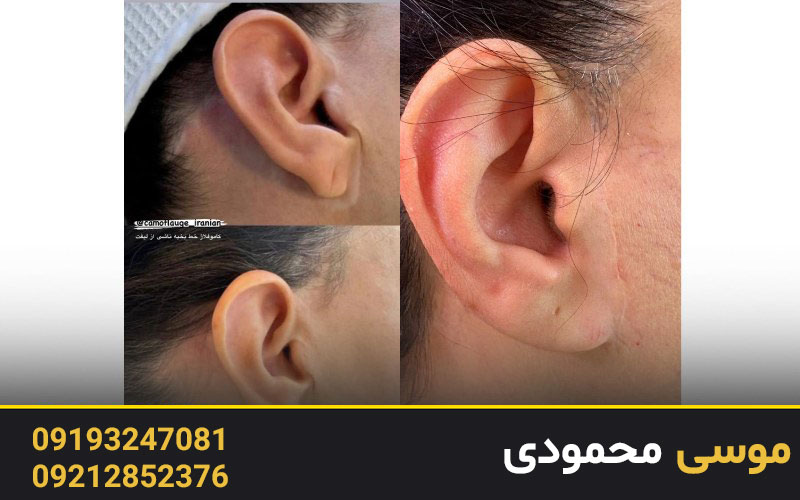 نکات مهم برای از بین بردن جای بخیه