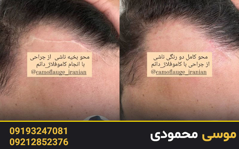 کاور خط بخیه جراحی در کلینیک میکرو غرب