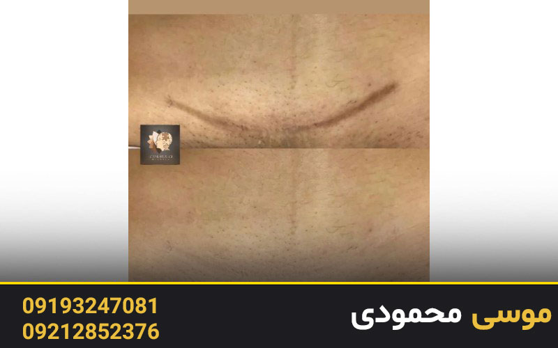 پوشش بخیه با تاتو چگونه امکان پذیر است؟