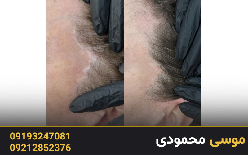 شناخت انواع جای بخیه یا اسکار