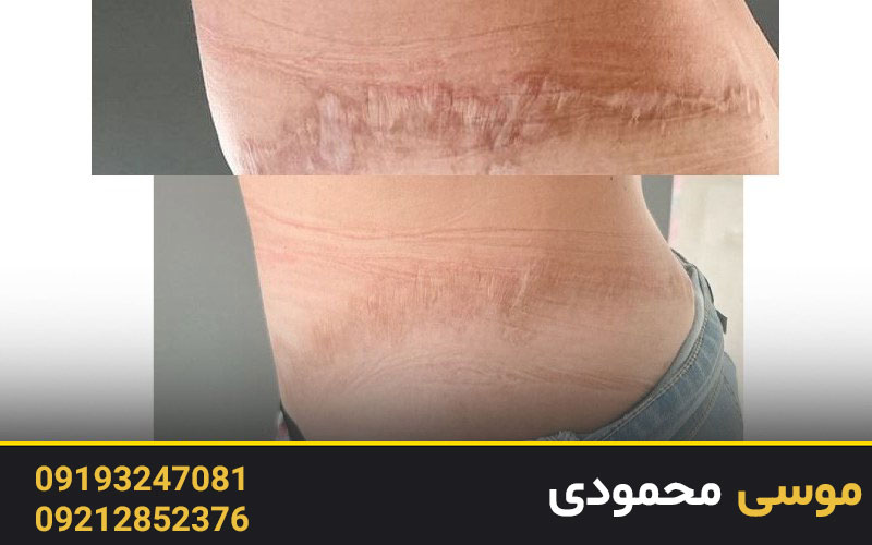 کاور خط بخیه جراحی به روش کاموفلاژ دایم