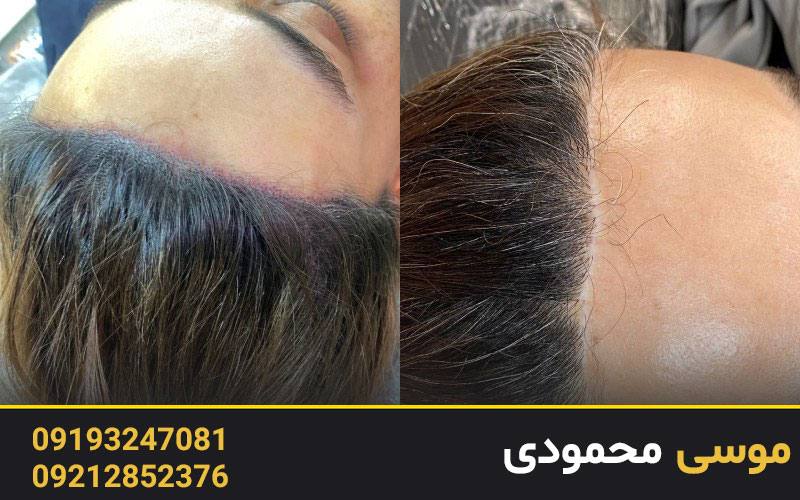 روش‌های کاور بخیه جراحی