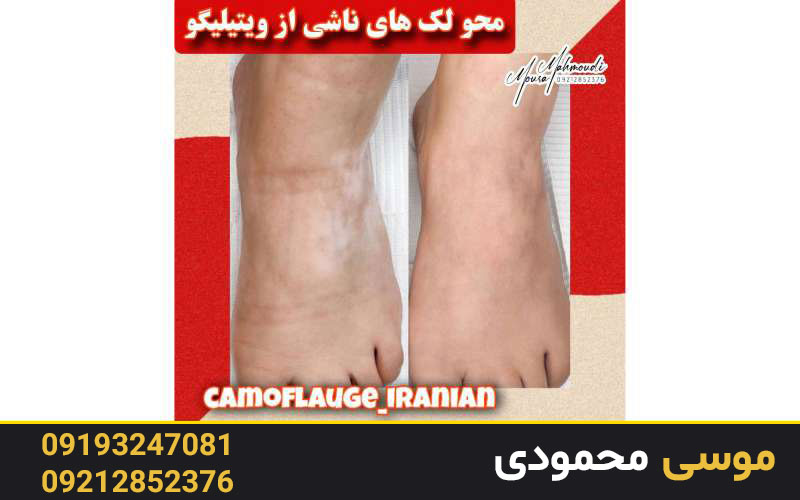 مراقبت‌های بعد از تاتو ویتیلیگو یا میکروپیگمنتیشن