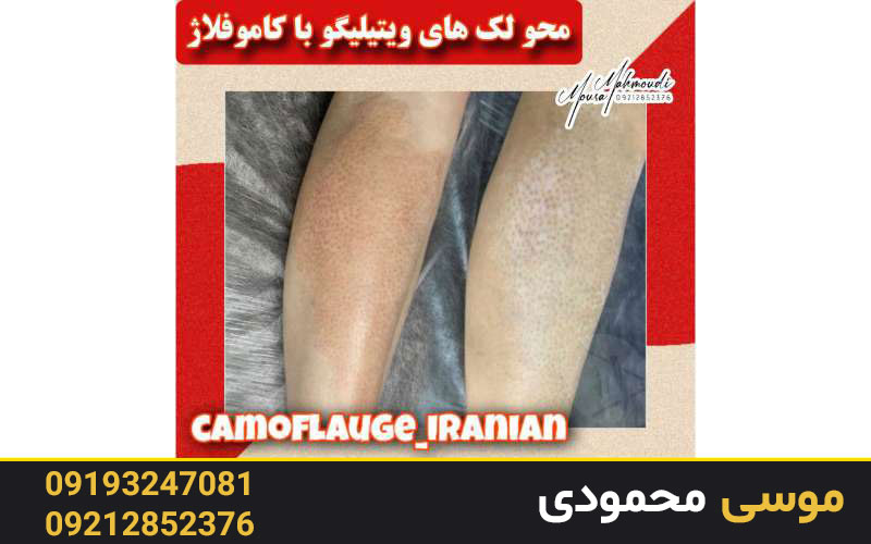 انجام خدمات تاتو ویتیلیگو